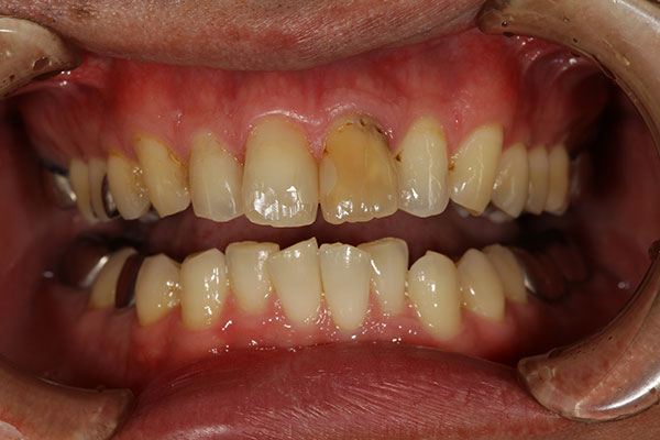 左上中切歯 前歯から1番目 の変色が気になるのでジルコニアでやりかえを希望された症例 岡田歯科医院